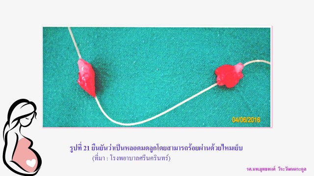 แนะไม่ควรใช้คำว่า “ทำหมันถาวร” เหตุในทางการแพทย์ไม่มีวิธีการใดคุมกำเนิดได้ 100%