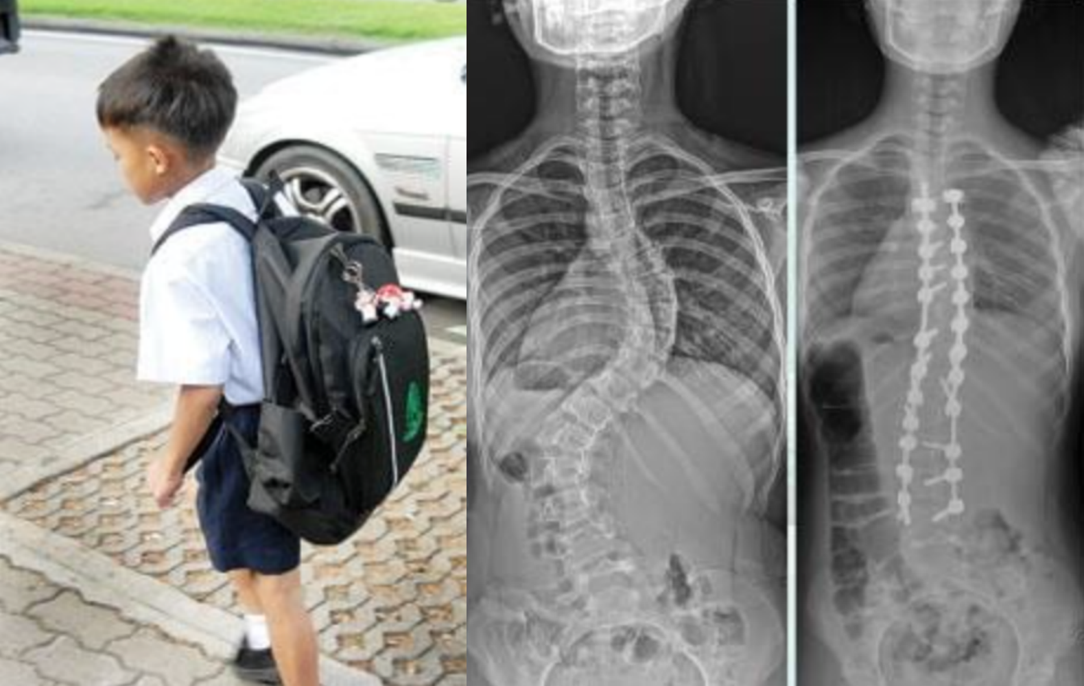 แพทย์เตือนเด็กนักเรียนแบกกระเป๋าหนัก เสี่ยงกระดูกสันหลังคด